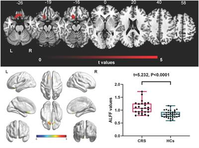 Intrinsic brain abnormalities in chronic rhinosinusitis associated with mood and cognitive function